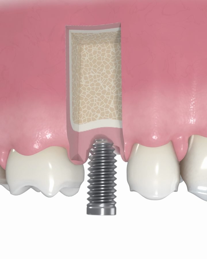 3D-Bild: aufgeschnittener Kieferknochen, darunter ein Implantat kurz vor dem Einsetzen