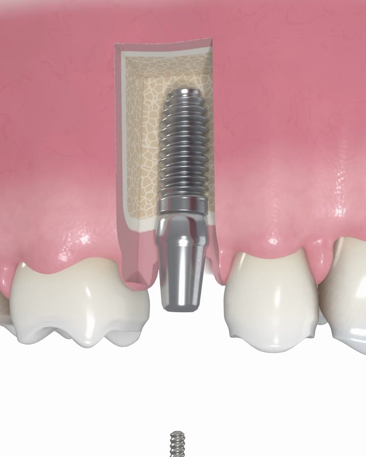 3D-Bild: Implantat im Knochen, darauf der metallische Aufbau für die Krone