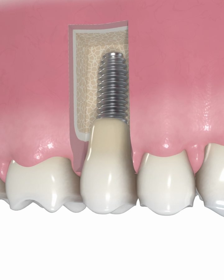 3D-Bild: fertige Krone auf dem Implantat zwischen den Nachbarzähnen